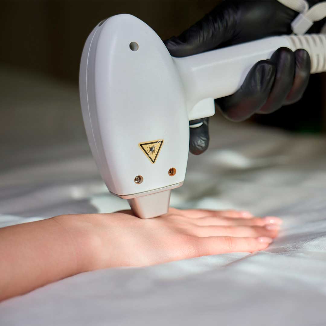 Лазерная эпиляция в Екатеринбурге