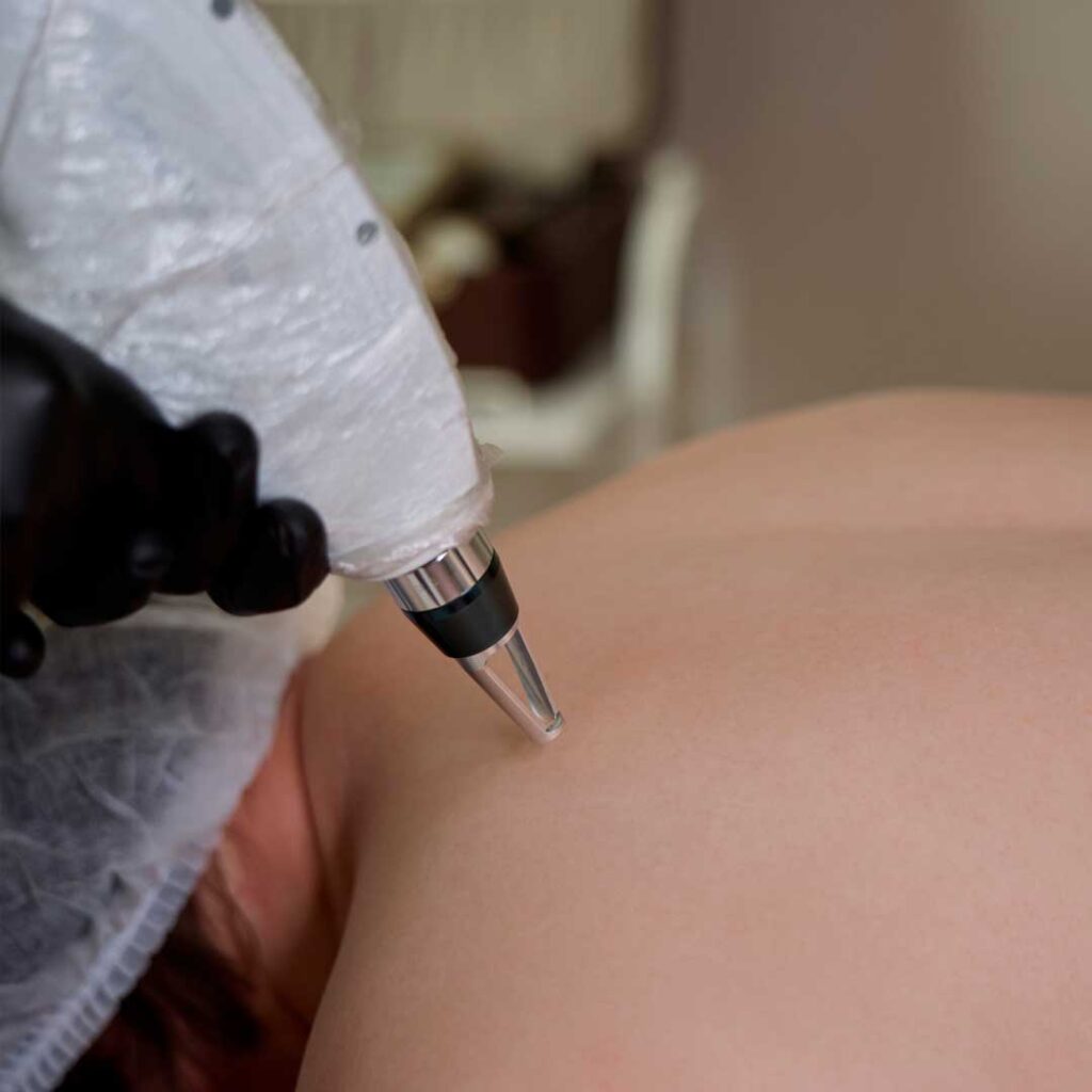 Лазерная эпиляция в Екатеринбурге